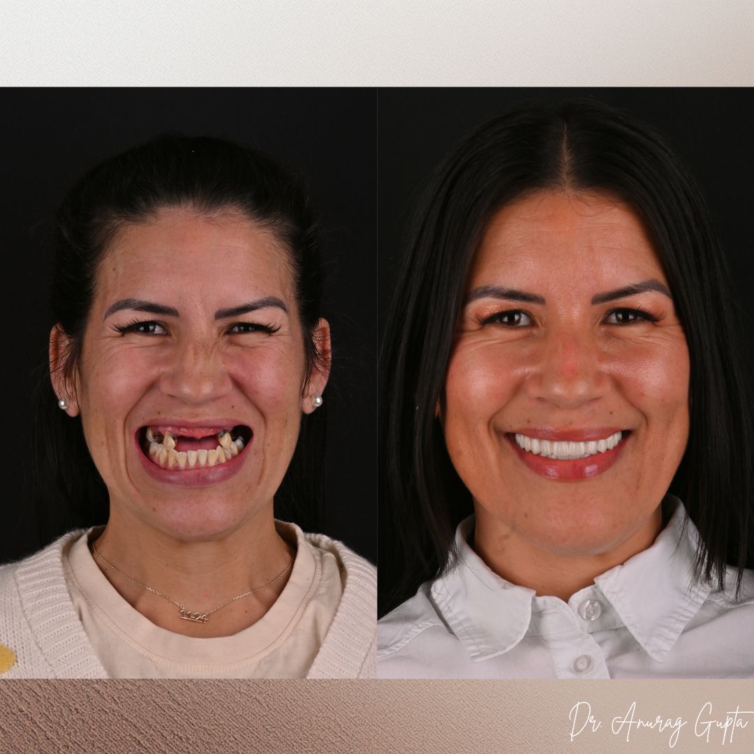 Full-face before and after photos of a complex full-arch nXtsmile All-on-X dental implant case at Grafton Dental Care in Grafton, MA — Dr. Anurag Gupta, DMD