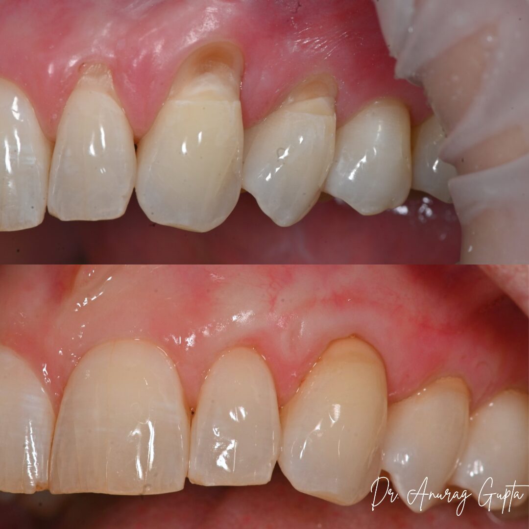 Before and after photos of connective tissue graft treatment for gum recession — front view, Grafton Dental Care, Dr. Anurag Gupta DMD
