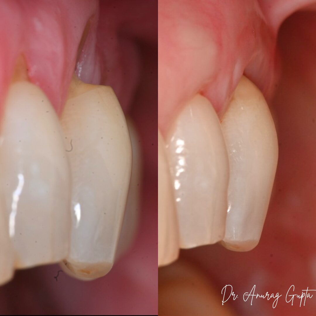 Before and after photos of the same connective tissue graft case from a side angle — Grafton Dental Care, Dr. Anurag Gupta DMD