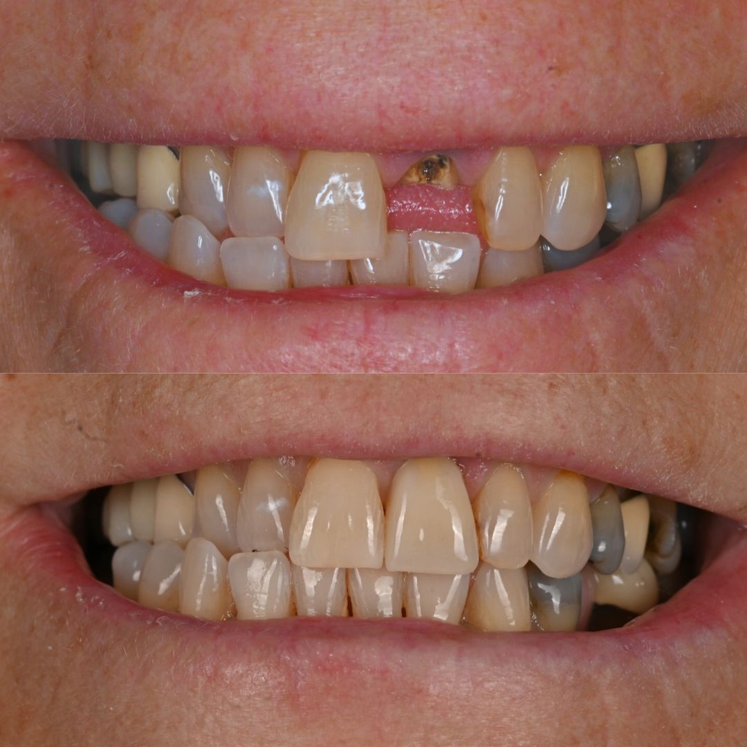 Before and after smile photos of a single front tooth replaced with a dental implant at Grafton Dental Care in Grafton, MA — Dr. Anurag Gupta, DMD