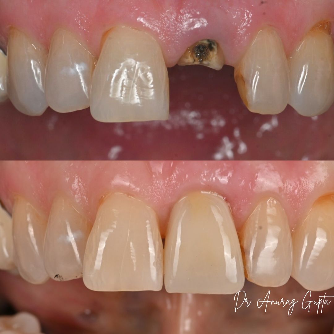Close-up before and after photos of a single anterior dental implant case — Grafton Dental Care, Dr. Anurag Gupta, DMD