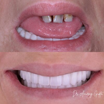 Before and after zirconia arch — missing and failing upper teeth replaced with full zirconia bridge at Grafton Dental Care, Grafton MA