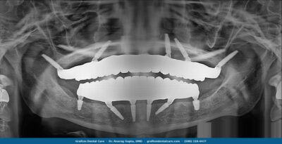 Panoramic X-ray showing pterygoid implants placed in the upper jaw at Grafton Dental Care — full arch reconstruction with implants angled into pterygoid bone