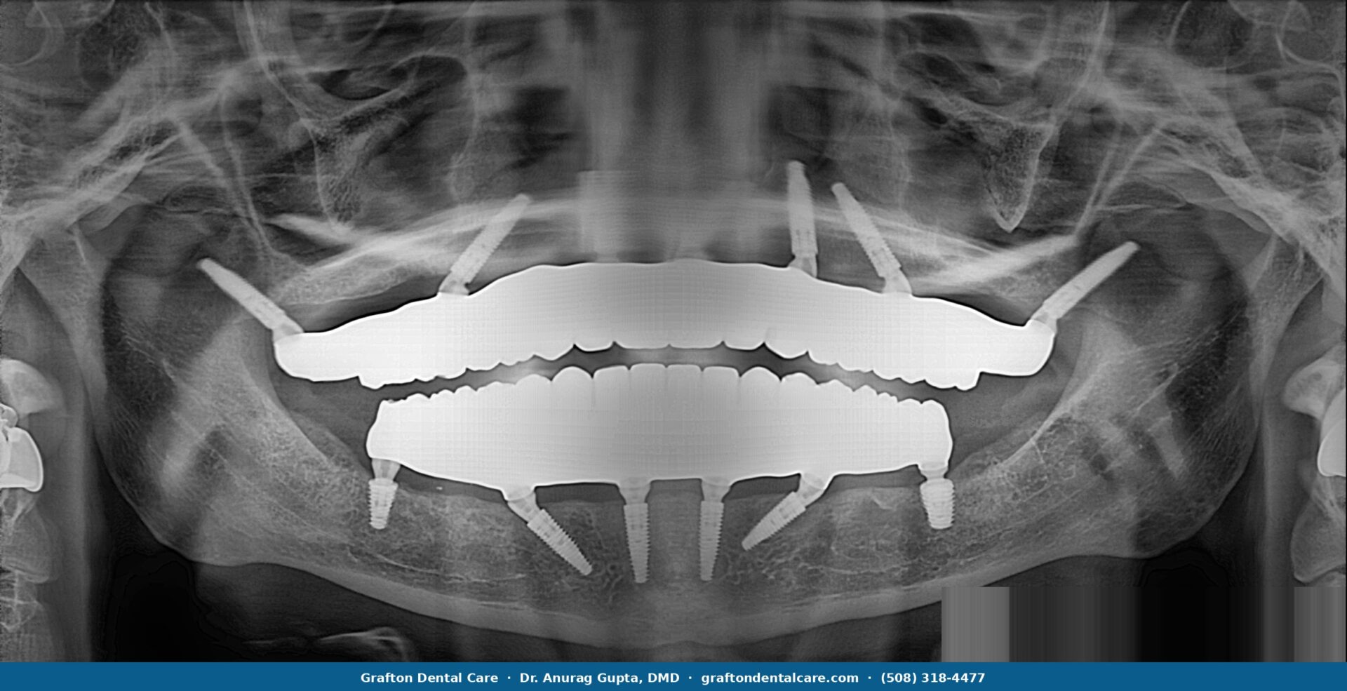 Panoramic X-ray showing pterygoid implants placed in the upper jaw at Grafton Dental Care — full arch reconstruction with implants angled into pterygoid bone